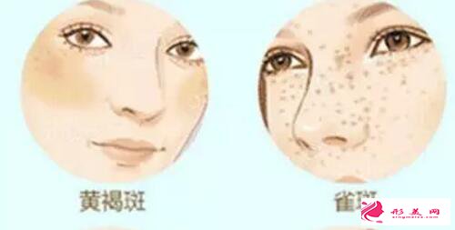 激光祛斑出現(xiàn)色素沉著正常嗎