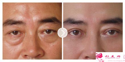 眼袋整形術(shù)并發(fā)癥_眼袋整形術(shù)并發(fā)癥有哪些