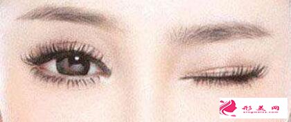 做雙眼皮手術(shù)會有變丑的風險嗎