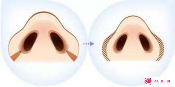 做鼻翼縮小手術(shù)會(huì)縮小鼻孔嗎