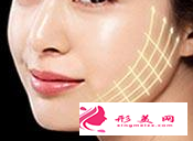 埋線提升不適合哪些人做