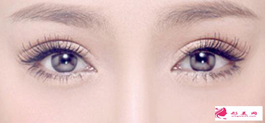 切開雙眼皮后有什么癥狀需要注意的