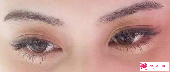 眼皮松弛也能做埋線雙眼皮嗎