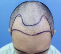 北京空軍總醫(yī)院植發(fā)價格表，男性植發(fā)案例