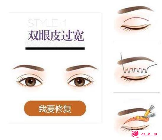 雙眼皮修復(fù)前后：假、寬、痕都能修復(fù)自然~