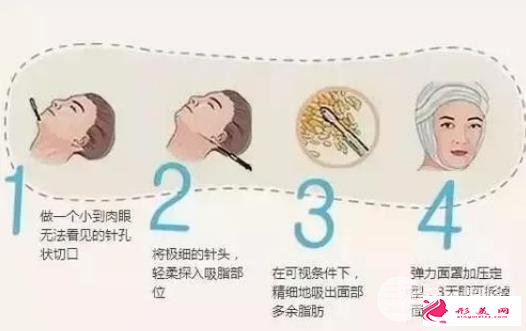 面部吸脂恢復(fù)期