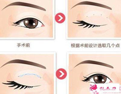 做膨體鼻部整形手術價格是多少