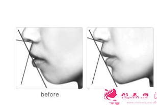 假體墊下巴消腫后就說明恢復(fù)了嗎