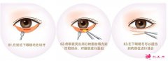 眼袋抽脂一周后能化妝嗎？