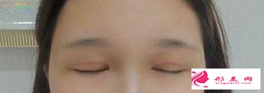 眼綜合拯救了我的正泡眼，選擇醫(yī)生是關(guān)鍵