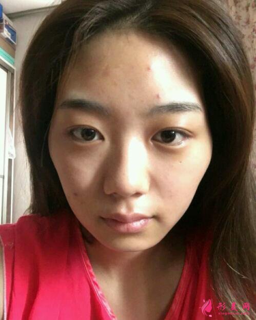 深圳非凡整形醫(yī)院面部填充好嗎？真人案例圖反饋