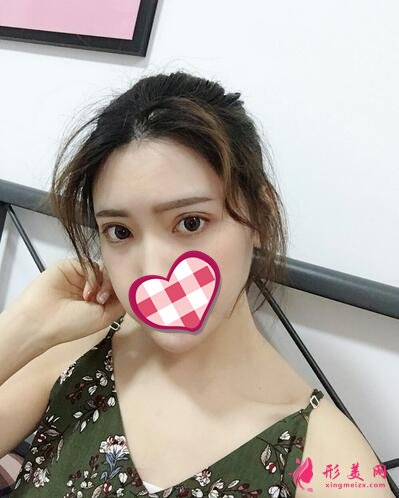 深圳美麗方案醫(yī)療美容姚堯自體脂肪填充心形臉案例