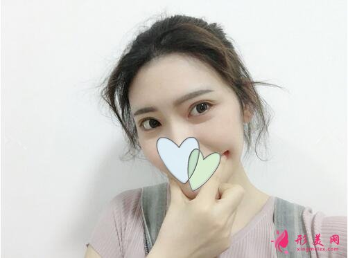 深圳美麗方案醫(yī)療美容姚堯自體脂肪填充心形臉案例