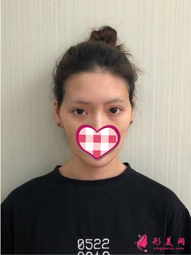 深圳美麗方案醫(yī)療美容姚堯自體脂肪填充心形臉案例