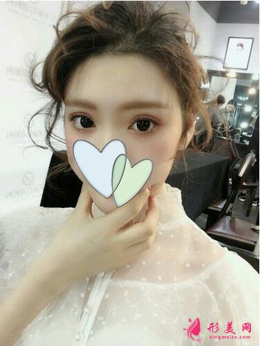 深圳美麗方案醫(yī)療美容姚堯自體脂肪填充心形臉案例