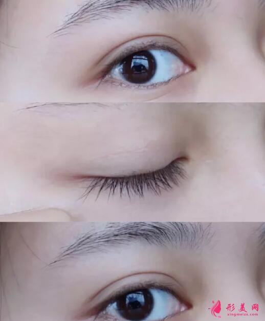 真的有無痛雙眼皮手術(shù)嗎?怕疼的寶貝看一看