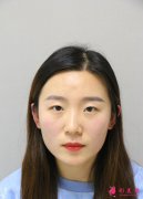 北京301醫(yī)院開雙眼皮那個(gè)醫(yī)生做的好？整形案例效果分享