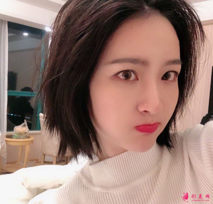 深圳領(lǐng)醫(yī)醫(yī)療美容隆鼻效果圖 術(shù)前術(shù)后對比