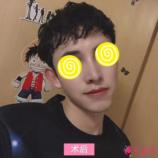 【案例】深圳人民醫(yī)院隆鼻案例，三甲技術(shù)確實(shí)不錯(cuò)！