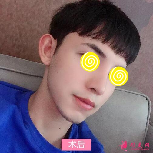 【案例】深圳人民醫(yī)院隆鼻案例，三甲技術(shù)確實(shí)不錯(cuò)！