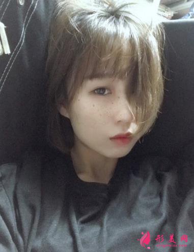 新反饋!深圳博愛醫(yī)院整形美容科祛斑案例~