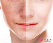 廣州整形醫(yī)院做激光祛斑大概要多少錢(qián)？