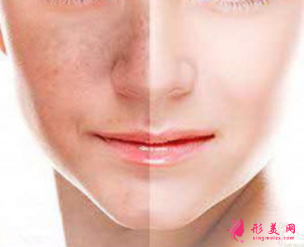 做激光祛斑大概要多少錢