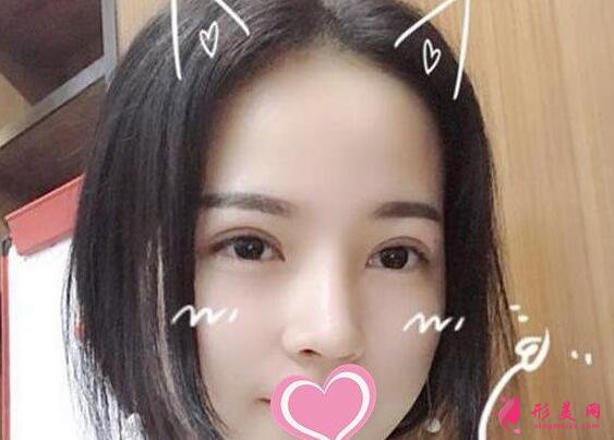 李信鋒做鼻子手術術后第17天