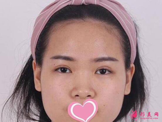 李信鋒做鼻子手術術前