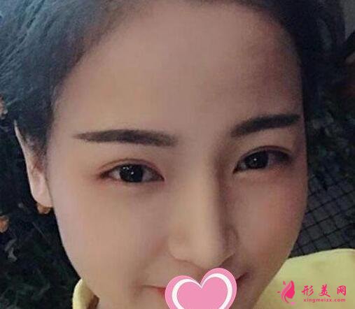 李信鋒做鼻子手術術后第67天