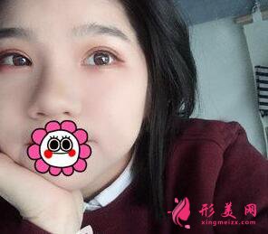 深圳yestar?？溯x雙眼皮手術(shù)術(shù)后半年