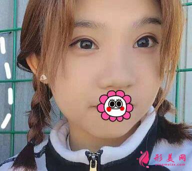 深圳yestar牛克輝雙眼皮手術(shù)術(shù)后半年