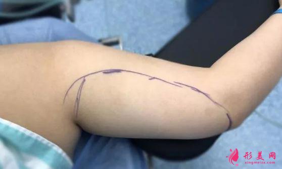 深圳張亞軍醫(yī)生做手臂吸脂手術術前