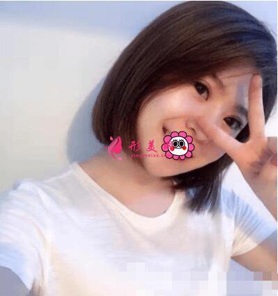 北京協(xié)和醫(yī)院整形外科雙眼皮術(shù)后效果圖，附整形美容價(jià)格表