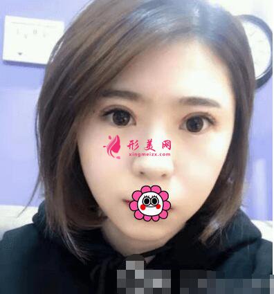 北京協(xié)和醫(yī)院整形外科雙眼皮術(shù)后效果圖，附整形美容價(jià)格表