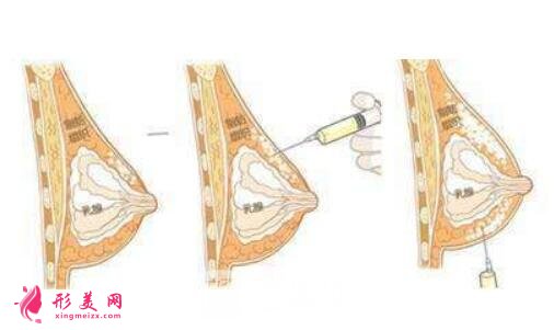 上海九院自體脂肪隆胸價(jià)格是多少?2022價(jià)目表分享~