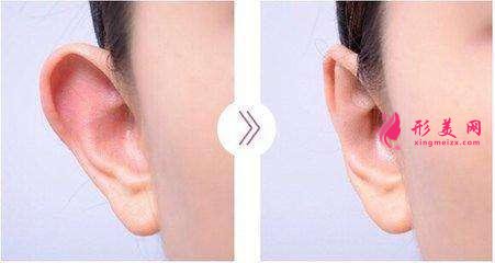 長沙星雅招風(fēng)耳矯正效果好嗎