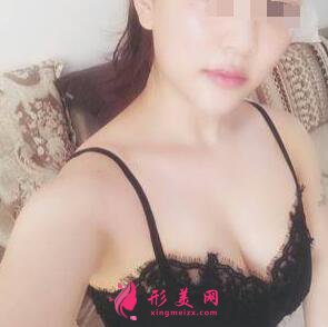 自體脂肪隆胸術(shù)后第23天