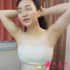 自體脂肪隆胸術(shù)后拆線