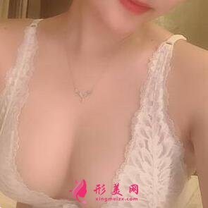 自體脂肪隆胸術(shù)后第56天