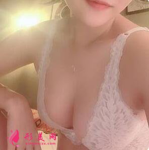 自體脂肪隆胸術(shù)后第56天