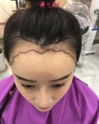 女性毛發(fā)種植術(shù)后98天效果反饋，很驚人就對(duì)了！