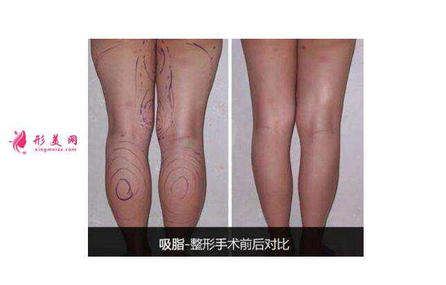 小腿吸脂減肥效果