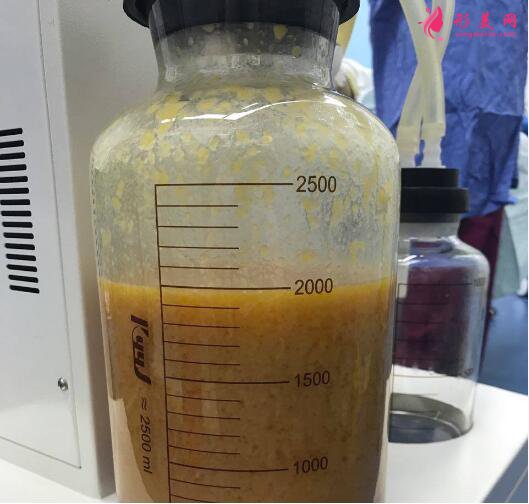 胳膊吸脂價(jià)格