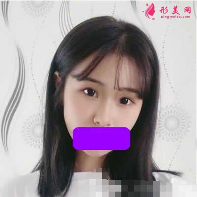 隆鼻術(shù)后恢復(fù)