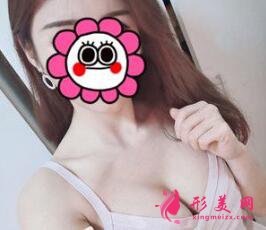 假體隆胸后需要注意的事項