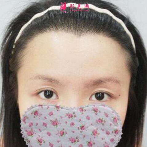 毛發(fā)移植手術(shù)效果圖，發(fā)際線種植