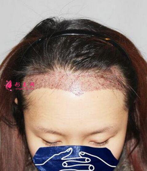 毛發(fā)移植手術(shù)效果圖，發(fā)際線種植