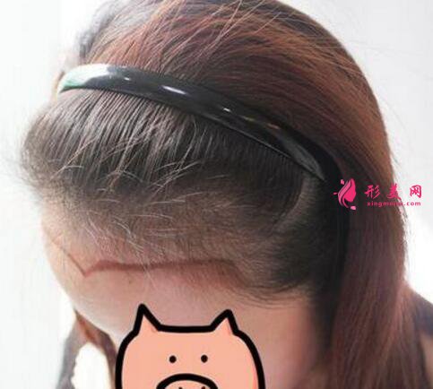 毛發(fā)移植手術(shù)效果圖，發(fā)際線種植