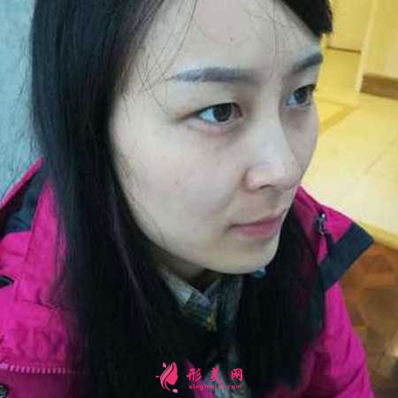 重慶華美整形醫(yī)院的雙眼皮成功案例